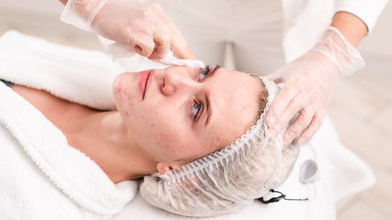 What-are-the-best-skin-treatments-for-acne-960x540-1